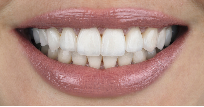 Care sunt cele mai bune coroane dentare?