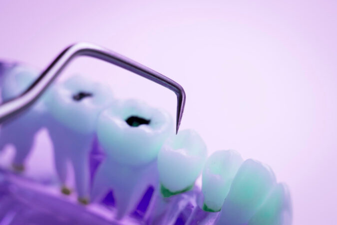 Cate implanturi dentare se pot pune odata ?